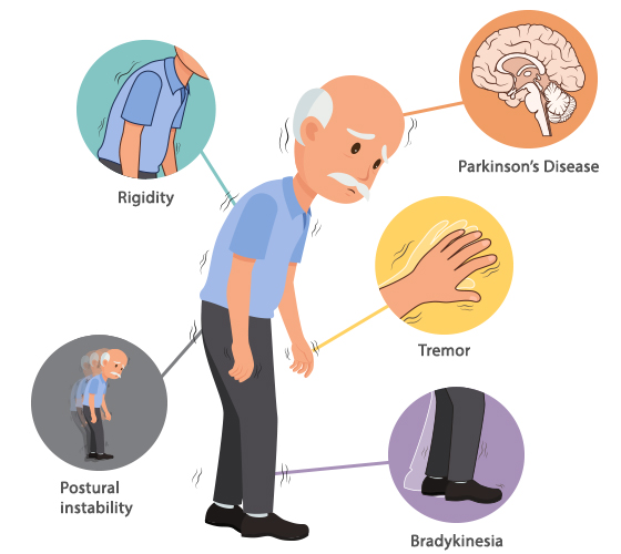 treatment-of-postural-instability-in-parkinson-s-disease